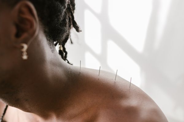 TMJ Acupuncture